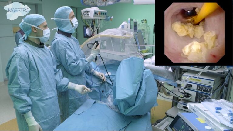 Removing Kidney Stones with Laser Technology A Comprehensive Guide for 2024