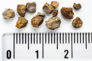 Removing Kidney Stones with Laser Technology A Comprehensive Guide for 2024